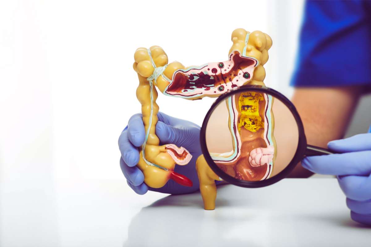 Cancro al colon, rivoluzione screening precoce